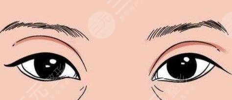 割雙眼皮恢復(fù)過程圖:恢復(fù)過程