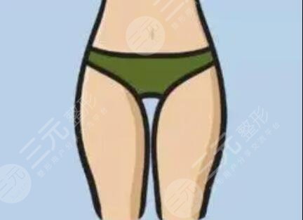 深圳西爾維婭整形醫(yī)院大腿吸脂案例