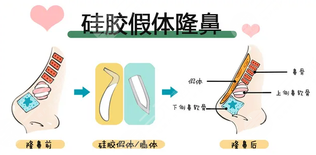 重慶華美李超醫(yī)生隆鼻術(shù)后一周