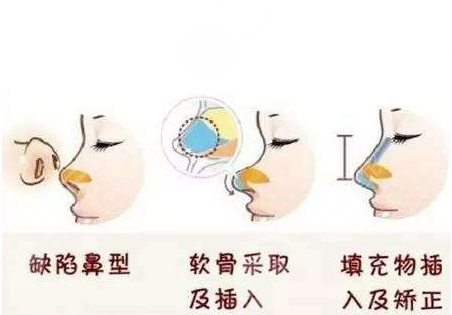 重慶華美李超醫(yī)生隆鼻術(shù)后5周