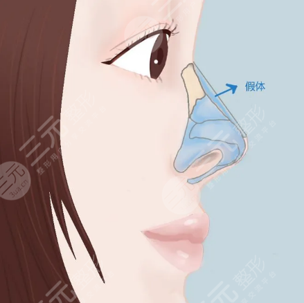 華美李超做鼻子后9天