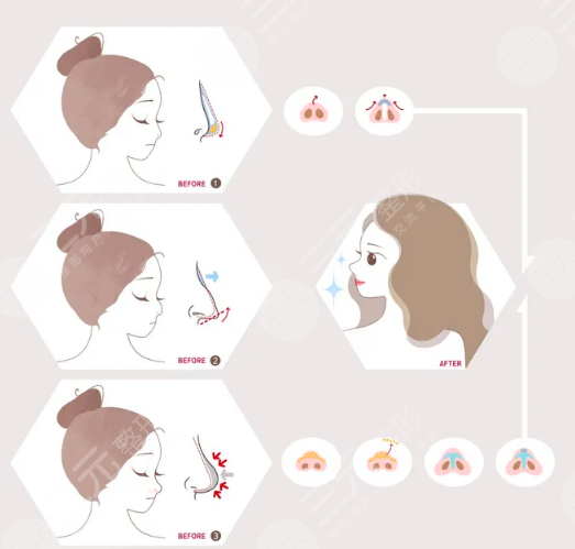 華美李超做鼻子后49天