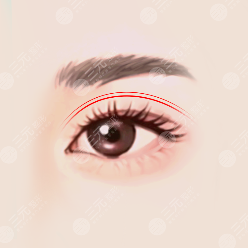 曹仁昌醫(yī)生雙眼皮修復(fù)案例果圖分享:術(shù)前