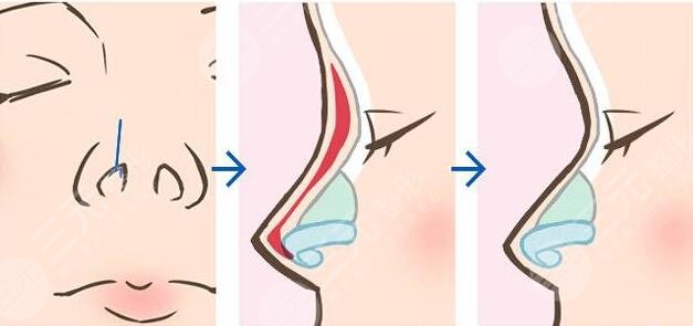 羅匯東做鼻子案例果術(shù)后拆線