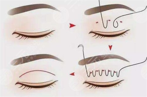 漢中中心醫(yī)院雙眼皮案例前