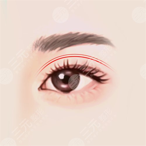 漢中中心醫(yī)院雙眼皮案例后