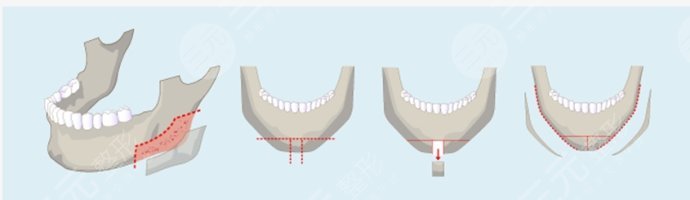 磨顴骨前后對比圖