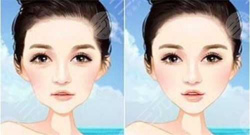 真人體驗熱拉提術(shù)后2個月