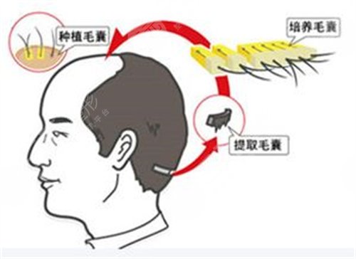 植發(fā)術(shù)后注意事項