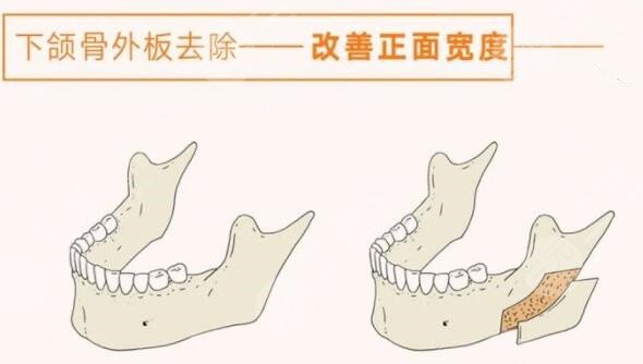 磨下頜角手術(shù)過(guò)程圖恢復(fù)記錄，真人下頜角磨骨對(duì)比圖~