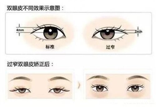 張誠教授做眼修復案例,7天get自然靈動大雙眼