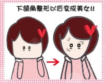 上海華美下頜角真人案例對比