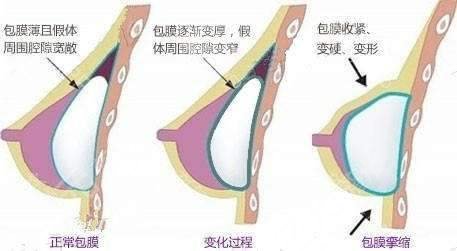 假體隆胸的注意事宜有哪些？