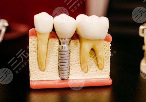 2022全國種植牙價格表種植牙的價格表，品牌、醫(yī)生、規(guī)模影響價格