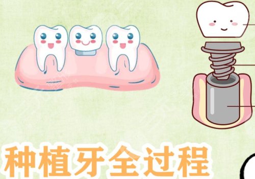 種植牙的原理介紹