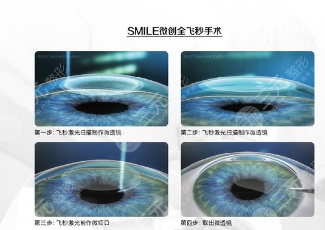 視眼激光手術(shù)恢復(fù)時(shí)間多久