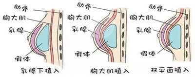 假體隆胸恢復(fù)果圖片分享，記錄術(shù)后每一天的變化~