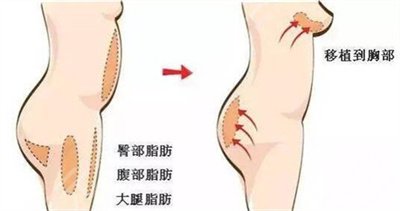 假體隆胸恢復(fù)果圖片分享，記錄術(shù)后每一天的變化~