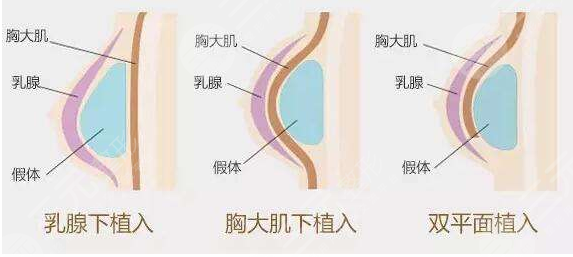 美國娜綺麗假體術前要做什么準備？