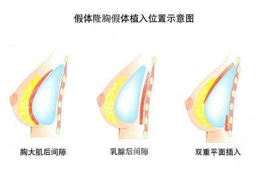 美國娜綺麗假體術后應該如何進行保養(yǎng)？