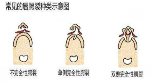 唇腭裂鼻子修復(fù)多大年齡合適？唇腭裂修復(fù)過(guò)程和時(shí)間需要多久？