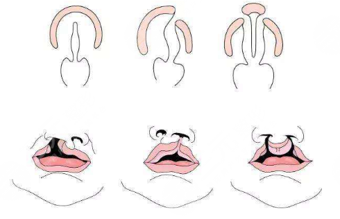 唇腭裂鼻子修復(fù)多大年齡合適？