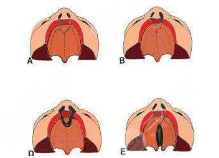 唇腭裂修復(fù)過(guò)程和時(shí)間需要多久？