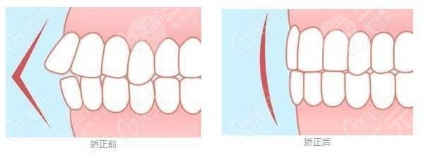 華西口腔醫(yī)院牙齒矯正前