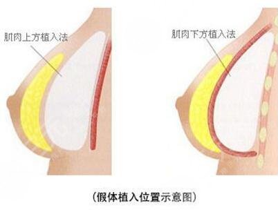 魔滴和曼托怎么選擇？
