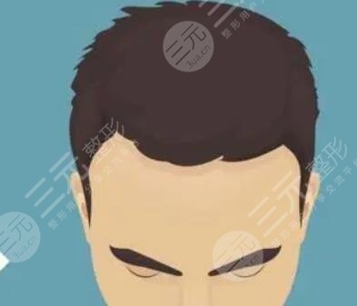 長沙新生植發(fā)醫(yī)院胡須種植案例分享