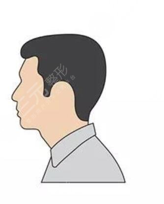 長沙新生植發(fā)醫(yī)院胡須種植案例分享