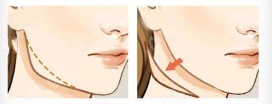 下頜角手術(shù)