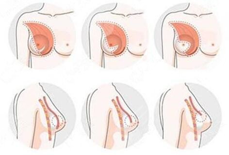 魔滴假體隆胸為什么價(jià)格有高有低？