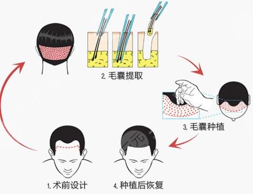 頭發(fā)種植項(xiàng)目科普