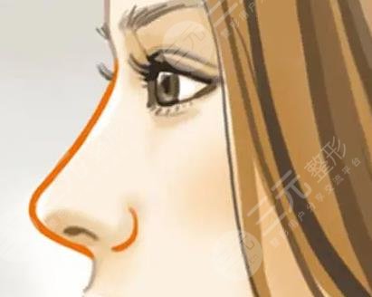 肋骨隆鼻1-7天恢復(fù)過(guò)程圖分享！真人隆鼻體驗(yàn)經(jīng)歷分享+附收費(fèi)價(jià)格表