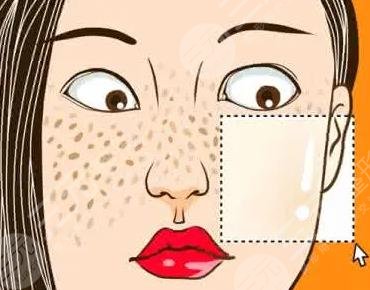 激光去黃褐斑項(xiàng)目