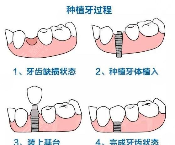 種植牙手術(shù)科普簡(jiǎn)介