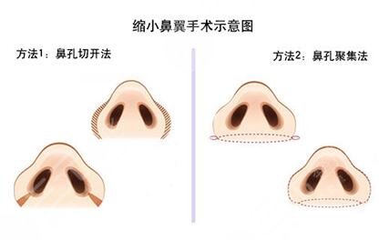 骨膜下隆鼻整形手術(shù)怎么做的？哪種情況適合做？