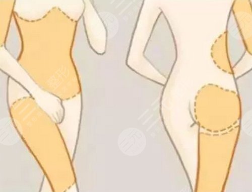 打注射瘦腿多少錢？多少錢一針比較合適？