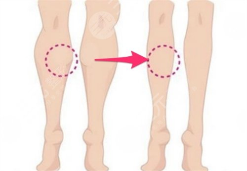 注射瘦腿有嗎 注射注射瘦腿前后對(duì)比圖