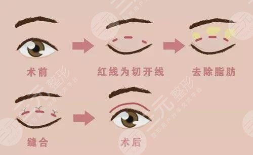 遺傳性單眼皮如何變雙眼皮?