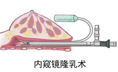 內(nèi)窺鏡隆胸手術(shù)