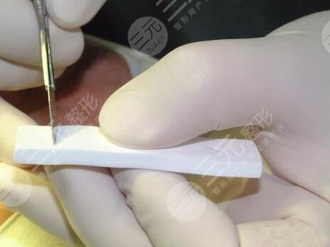 隆鼻前后對比果圖片