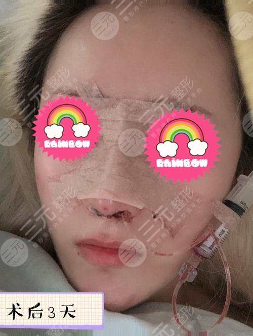 隆鼻前后對比果圖片