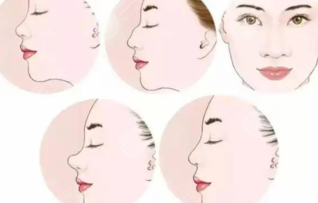 肋骨隆鼻三個(gè)月變化圖、手術(shù)前