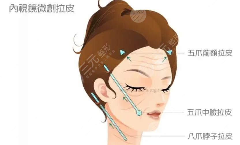 小切口拉皮手術(shù)對比照片