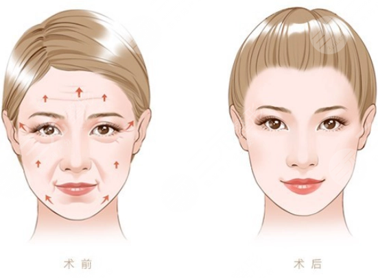小拉皮手術(shù)后7天照片對(duì)比圖來(lái)了