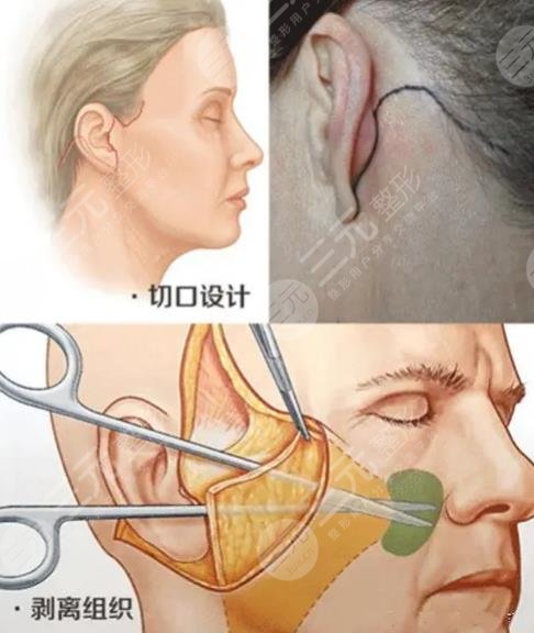 做小拉皮手術(shù)需要多少錢