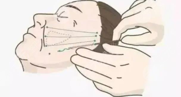 面部拉皮手術能維持幾年