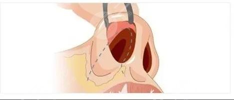 鼻子修復(fù)必須要滿3個(gè)月嗎？二次鼻整形術(shù)前指南！小白必看~